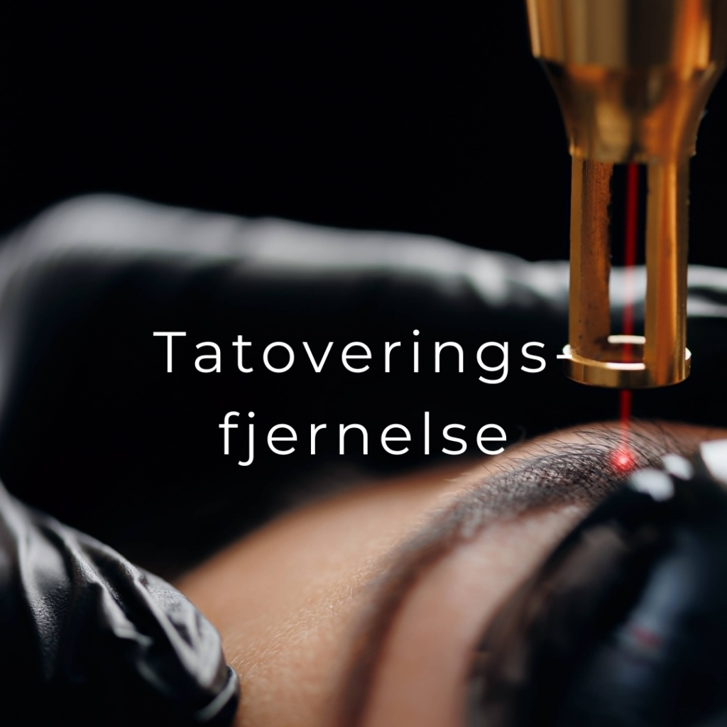 Tatoveringsfjernelse