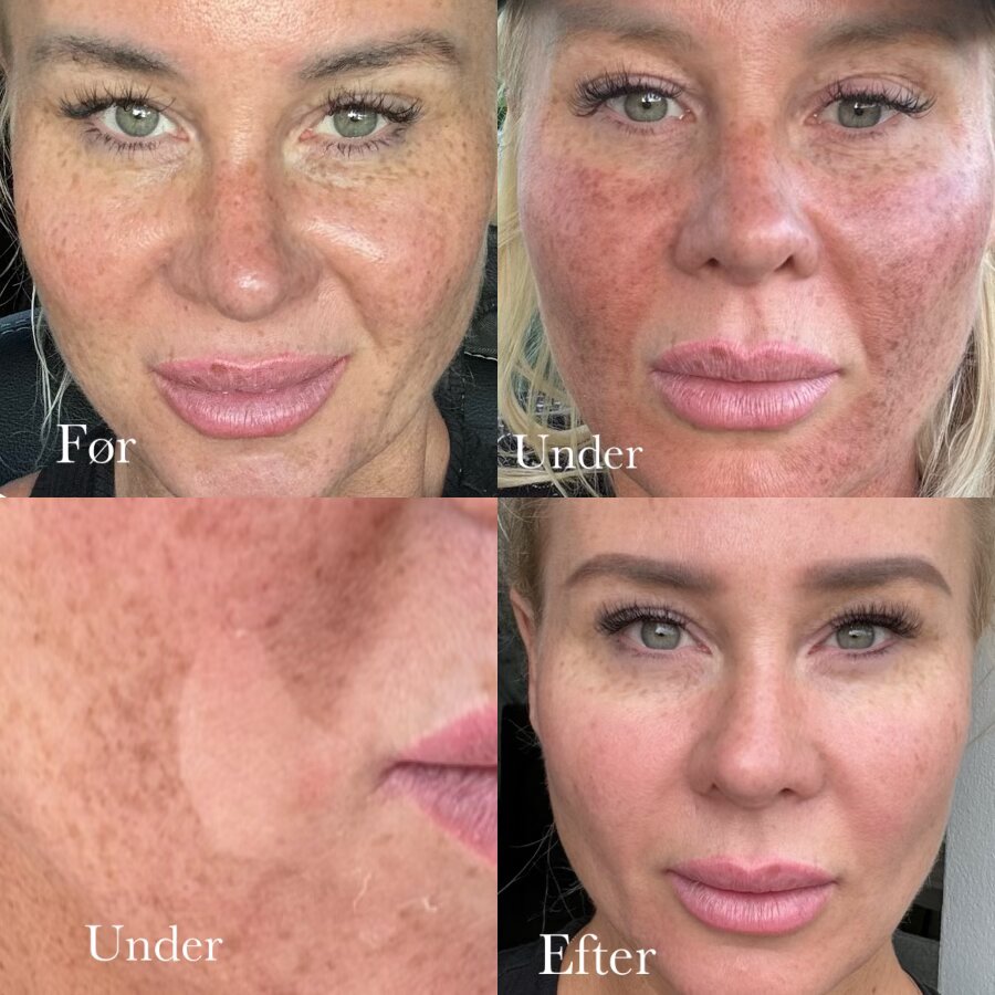 Jessner peeling Düwald Kolding SkinClub