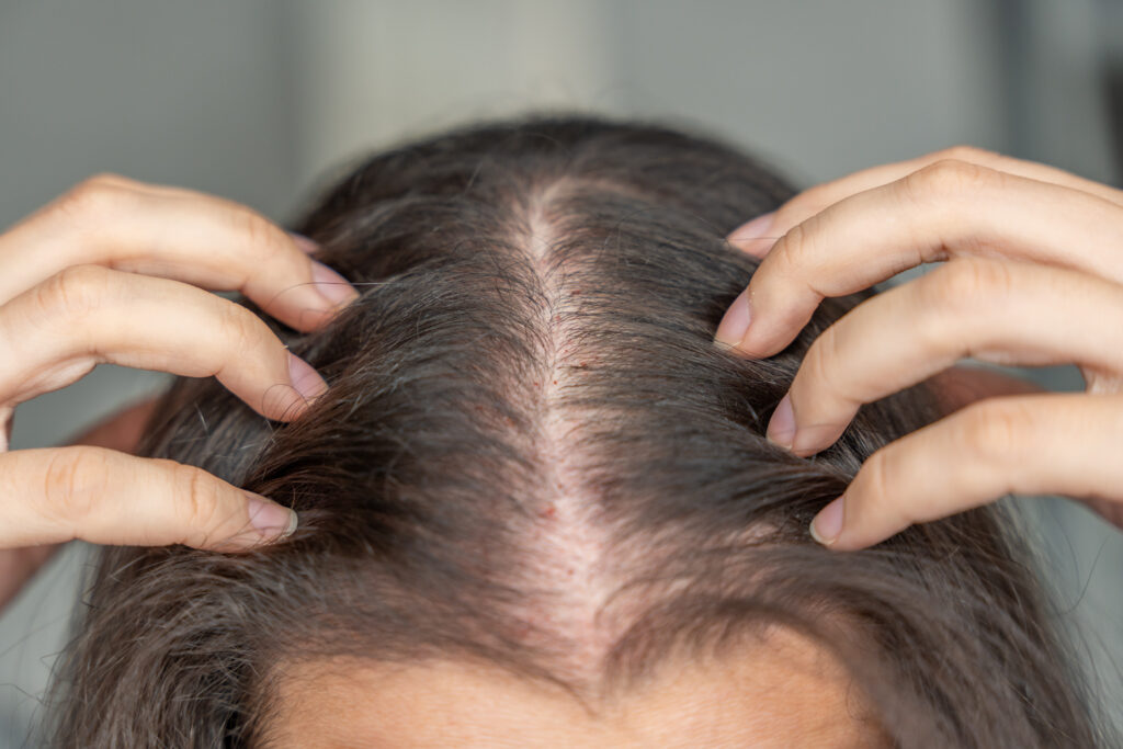 PRF behandling mod hårtab og hudforyngelse SkinClub Düwald Kolding