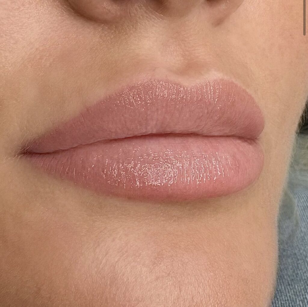 Fillers læber kindben Kolding Düwald SkinClub