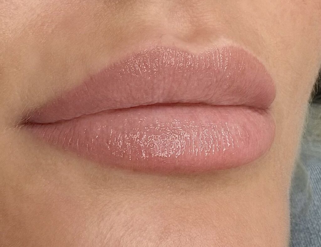 Fillers læber kindben Kolding Düwald SkinClub